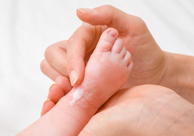 dermatitis-atopica-bebe